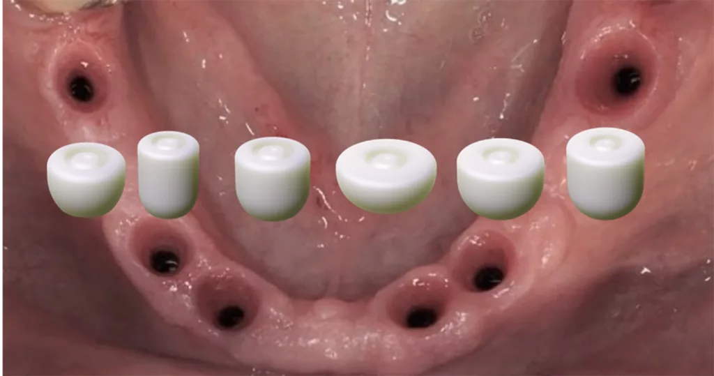 Abb. 1: Das Champions (R)Evolution Implantat wird mit bakteriendichtem Innenkonus mit integriertem Hexadapter und Abutment-Halteschraube inseriert.