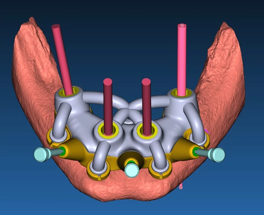 Abb. 2a: Erstellung der Implantationsschablone mit Führungshülsen und Fixierungspins, die über eine Steck-/Magnetverbindung an der Trägerschablone abgestützt ist (a). Durch die Volumenspaltung entsteht die Trägerschablone mit Resektionsprofil (b).