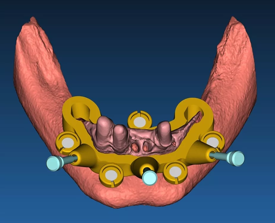 Abb. 2b: Erstellung der Implantationsschablone mit Führungshülsen und Fixierungspins, die über eine Steck-/Magnetverbindung an der Trägerschablone abgestützt ist (a). Durch die Volumenspaltung entsteht die Trägerschablone mit Resektionsprofil (b).