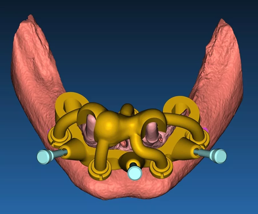 Abb. 3a: Mithilfe der Fixierungsschablone wird die knochengetragene Trägerschablone ausgerichtet und mit Fixierungspins am Kieferknochen befestigt (a), virtuelle Osteotomie des Knochensegments anhand des Resektionsprofils mit eingeblendeten Multiunit-Abutments (b).