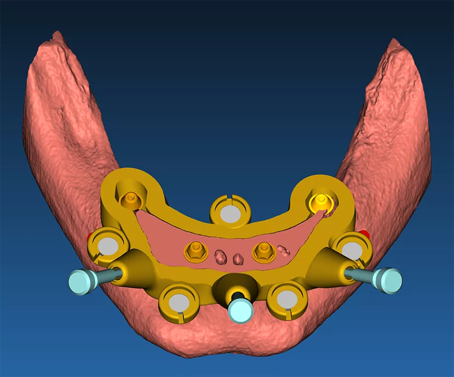 Abb. 3b: Mithilfe der Fixierungsschablone wird die knochengetragene Trägerschablone ausgerichtet und mit Fixierungspins am Kieferknochen befestigt (a), virtuelle Osteotomie des Knochensegments anhand des Resektionsprofils mit eingeblendeten Multiunit-Abutments (b).