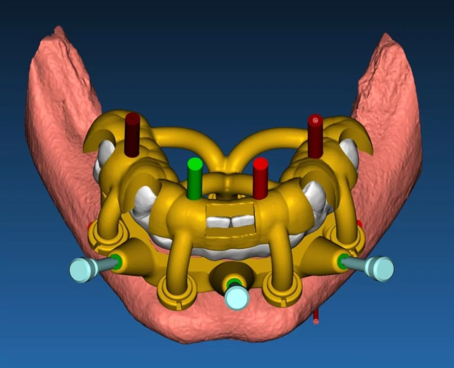 Abb. 4a: Zweite Trägerschablone mit provisorischer Sofortversorgung zur Verklebung auf provisorischen Abutments (a), okklusale Aufsicht und Darstellung der Klebekanäle und Einblendung der Multiunit-Abutments (b).