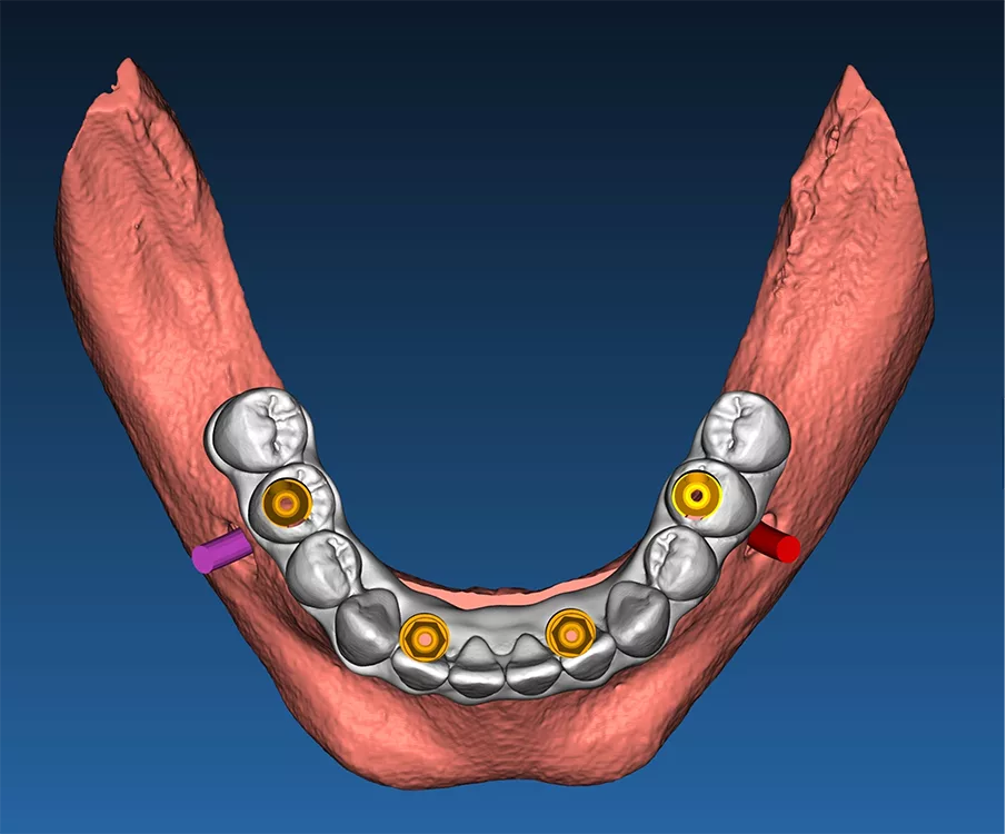 Abb. 4b: Zweite Trägerschablone mit provisorischer Sofortversorgung zur Verklebung auf provisorischen Abutments (a), okklusale Aufsicht und Darstellung der Klebekanäle und Einblendung der Multiunit-Abutments (b).