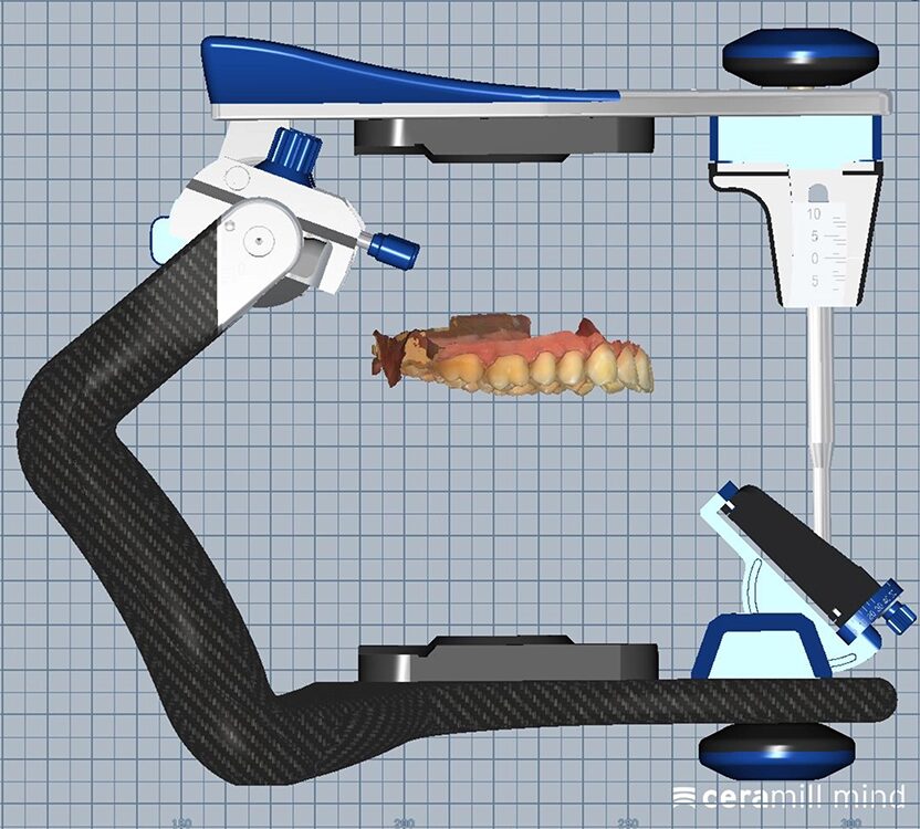 Abb. 1a: Modellmontage des Oberkiefers mittels Kopplungslöffel und digitalem Gesichtsbogen.