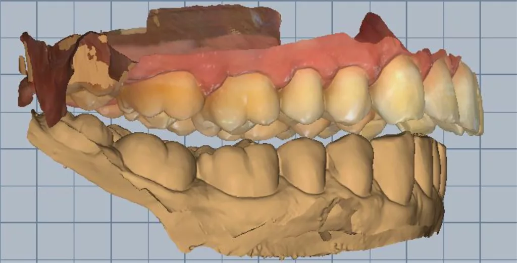 Abb. 2b: Modellmontage des Unterkiefers mittels eines Vestibulärscans in der therapeutischen Unterkieferposition, die am Patienten durch eine Kieferrelationsbestimmung gewonnen wurde.