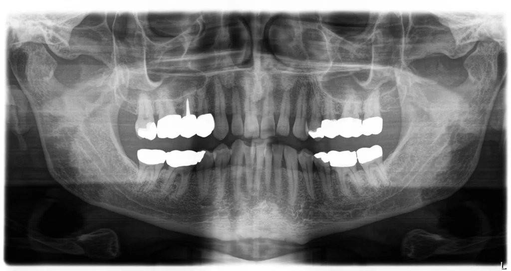 Abb. 8d: Intraorale Abbildungen (a–c) und ausgewählte radiologische bzw. klinische Befundunterlagen eines 74-jährigen männlichen Patienten (d u. e). Es handelt sich hier um einen emeritierten Akademiker, Nichtraucher und entsprechend den anamnestischen Angaben allgemeinmedizinisch unauffälligen Pensionär. Die klinisch-radiologische Diagnostik führte zur Diagnose eines konservierend und prothetisch weitestgehend suffizient versorgten Gebisses und einer generalisierten Parodontitis Stadium 3 Grad B. Die abgeplatzten Verblendungen einiger alter Kronen sind zwar nicht schön, störten den Patienten aber nicht weiter.