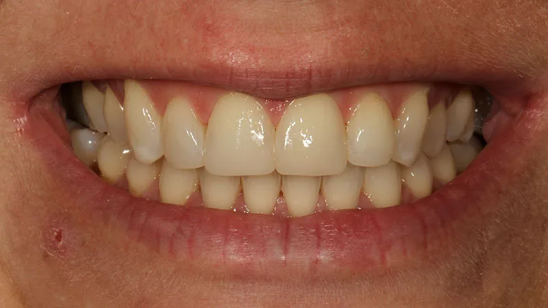 Abb. 17: Lippenbild bei einer Kontrolle nach fünf Wochen.