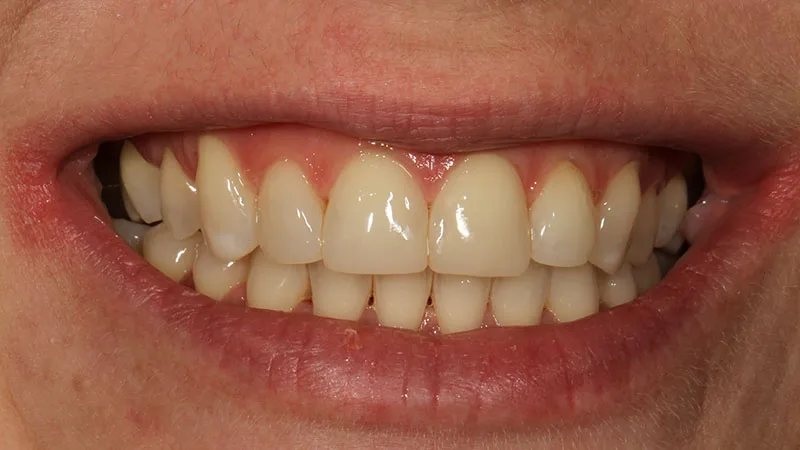 Abb. 21: Lippenbild bei einer Kontrolle nach einem Jahr.