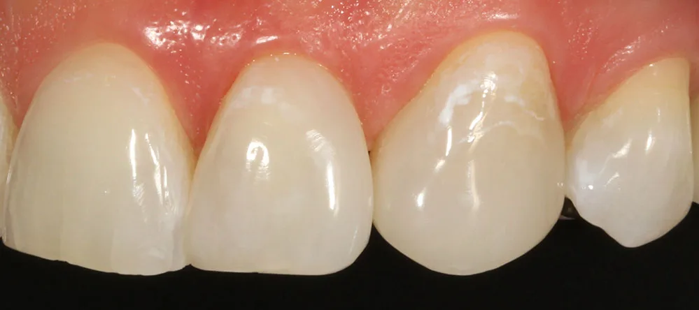Das Endergebnis überzeugt in Form und Farbe: 22: Filtek Supreme XTE A1B, 23: Venus Pearl Pure Light.