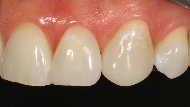 Abb. 36: Das Endergebnis überzeugt in Form und Farbe: 22: Filtek Supreme XTE A1B, 23: Venus Pearl Pure Light.