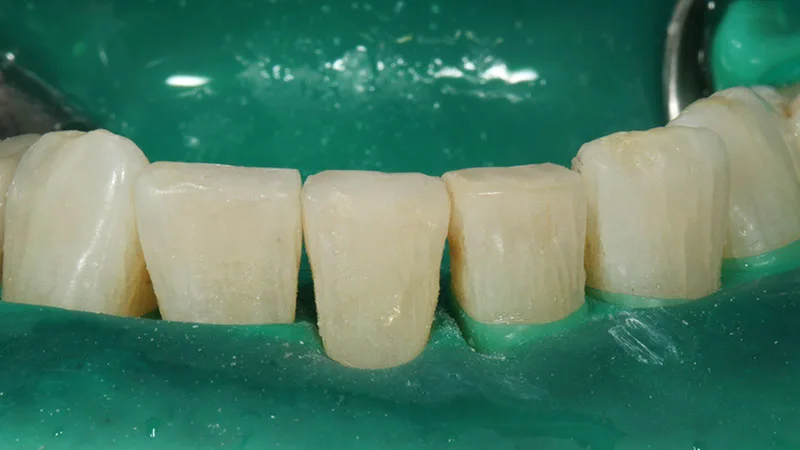 Abb. 38: Kompositversorgung mit einem pastösen Material – hier mit Venus Diamond Pure (Dark).