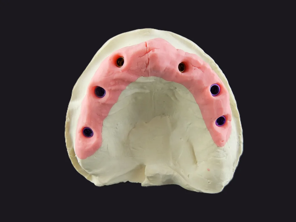Abb. 2a: Gute Ausgangssituation, lediglich das Implantat Regio 22 stand prothetisch nicht optimal.