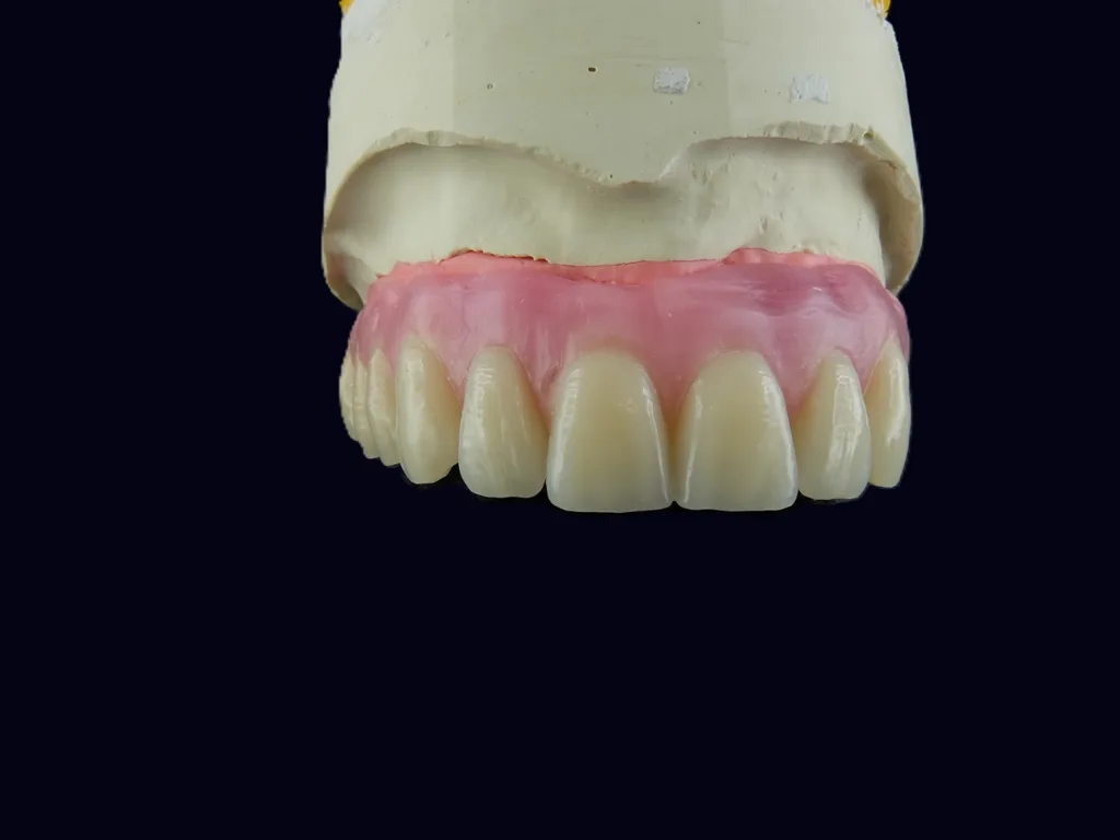 Abb. 2c: Gute Ausgangssituation, lediglich das Implantat Regio 22 stand prothetisch nicht optimal.