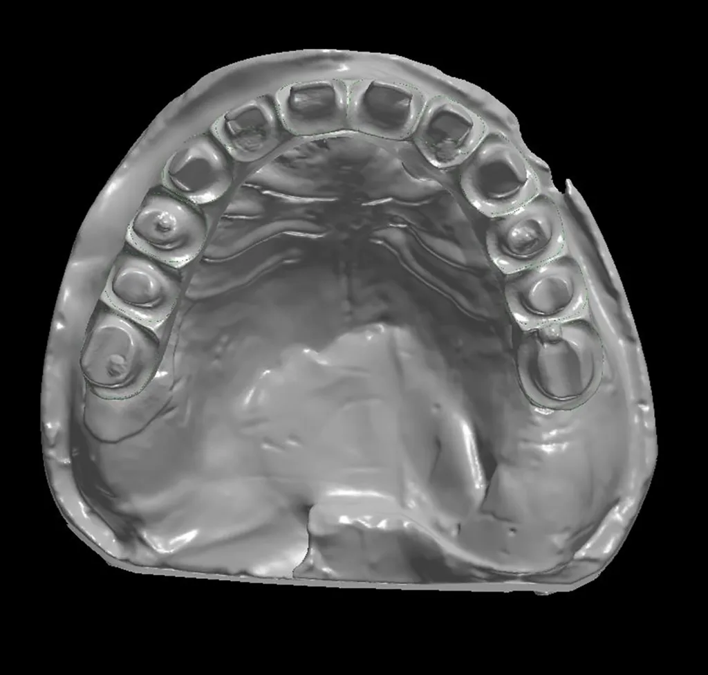 Abb. 7c: Scan des Gerüsts mit Wax-up (a und b) und ohne Wax-up (c und d).