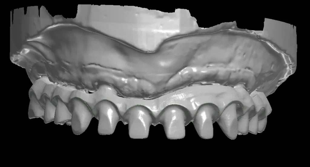 Abb. 7d: Scan des Gerüsts mit Wax-up (a und b) und ohne Wax-up (c und d).