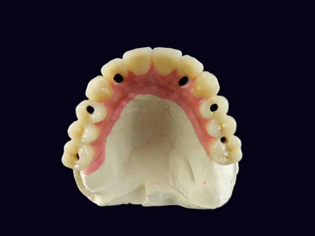 Abb. 13a: Der Gingiva-Anteil der Brücke kann einfach unterfüttert und angepasst werden.
