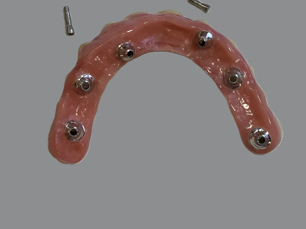 Abb. 13b: Der Gingiva-Anteil der Brücke kann einfach unterfüttert und angepasst werden.