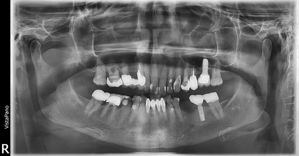 Abb. 2a: OPG vor Behandlungsstart: Der Knochen in regio 35 ist suffizient ausgeheilt. Der periimplantäre Knochen in regio 36 opB.