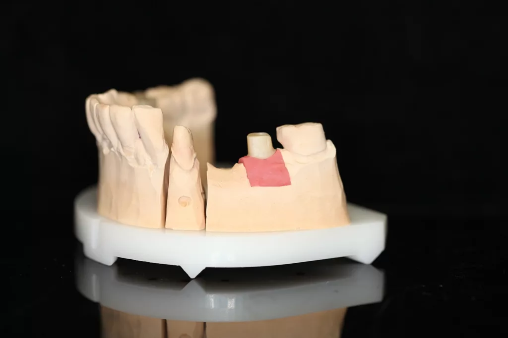 Abb. 2d: Meistermodell mit präpariertem Zahnstumpf 34. Für das Implantat wurde ein individuelles Zirkonabutment auf Titanklebebasis hergestellt.