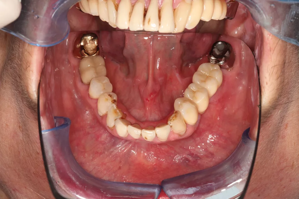 Abb. 2e: Klinische Situation bei Eingliederung: monolithische multilayer Zirkonbrücke auf präpariertem Zahnstumpf 34 und individuellem Zirkonabutment regio 36.