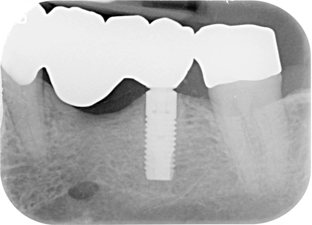 Abb. 2g: Röntgenkontrolle nach Eingliederung: periimplantärer Knochen regio 36 opB, suffizienter Randschluss.