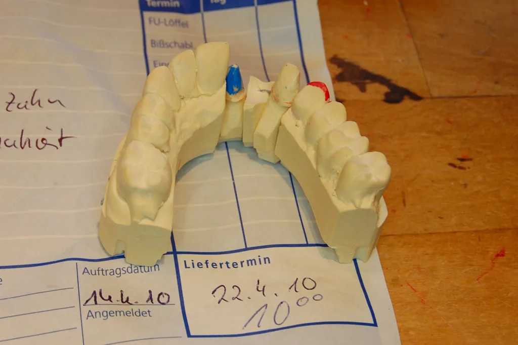 Abb. 1: Sägemodell aus der Dokumentationskiste mit dem stark konisch beschliffenen Zahn 21 und dem kaum präparierten Stiftaufbau des Eckzahnes 23.