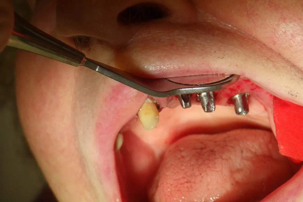 Abb. 12: Im Oberkiefer befinden sich nun nur noch nachpräparierte Implantataufbauten und zwei präparierte Zähne.