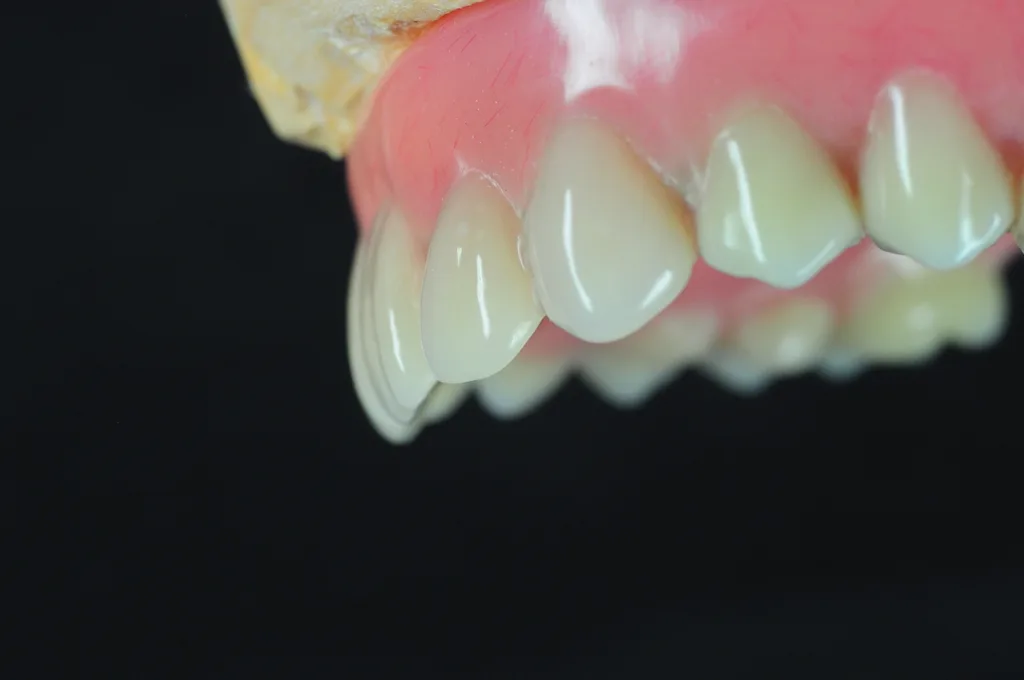 Abb. 21: Fertige Coverdenture.