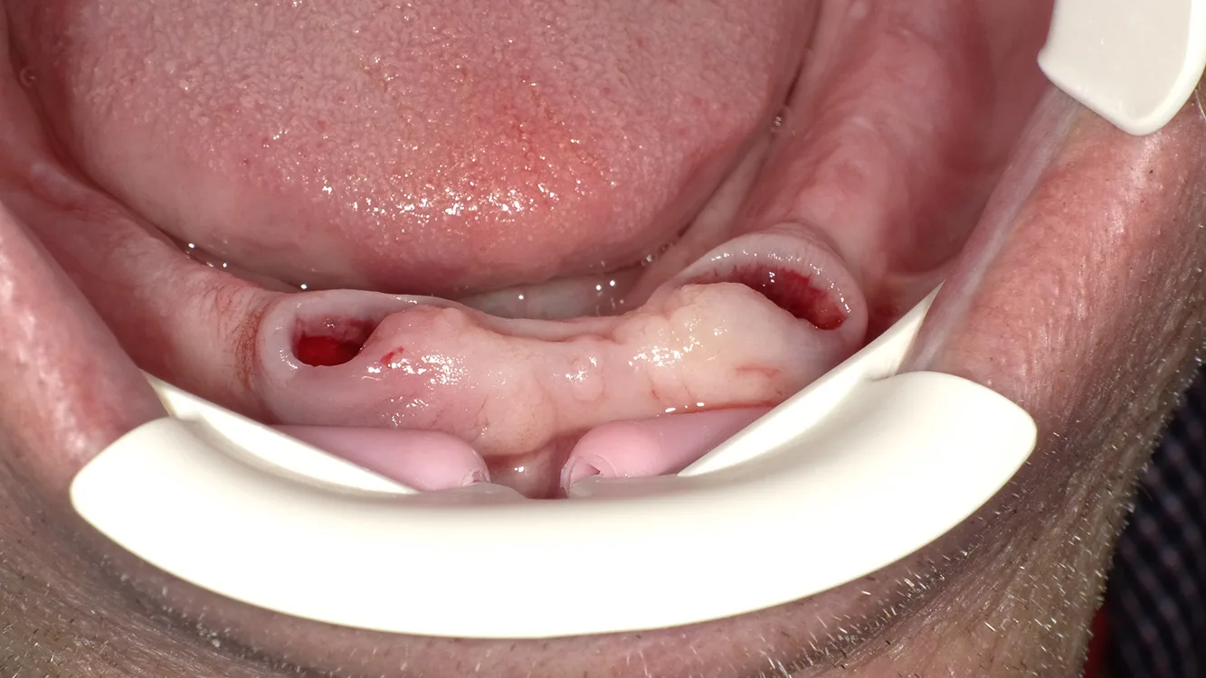 Situation Postextraktionem