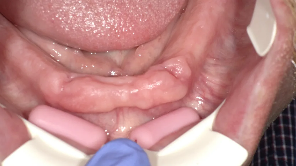 Situation nach 6 Tagen