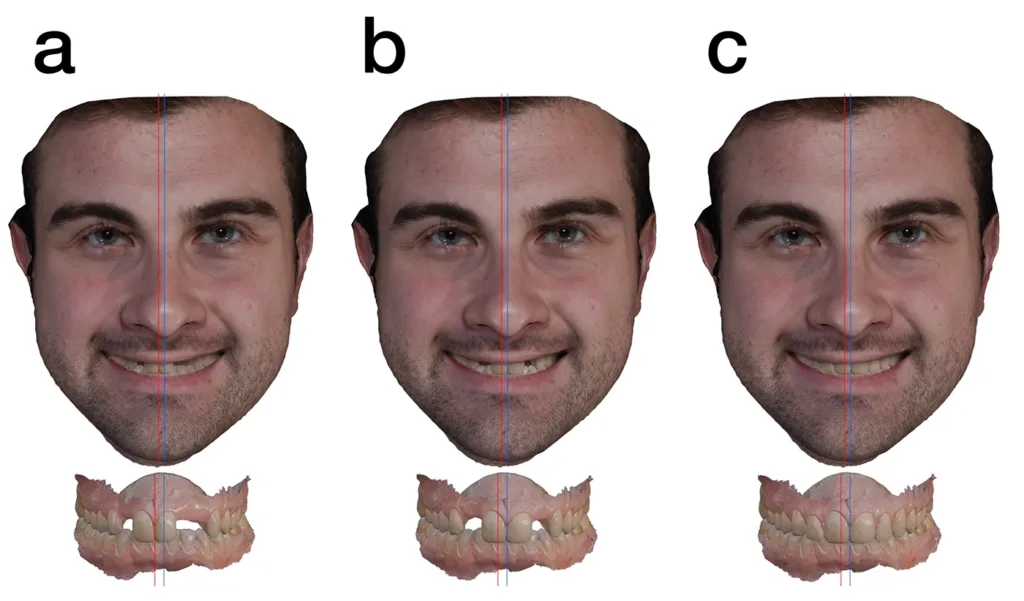 Abb. 1 a-c: Fallsimulation mit 3D-Gesichtsscans (Vectra M3, 3D Imaging System) und Intraoralscans (Trios 4, 3Shape) einer bilateralen Aplasie der oberen lateralen Schneidezähne (rote Linie: dentale Mittellinie, blaue Linie: Gesichtsmitte) überlagert in einer CAD-Software (Exocad): Initialer Gesichtsscan (a), überlagert mit intraoralem Scan, nach kieferorthopädischer Behandlung und Implantatinsertion (b), definitive prothetische Versorgung der oberen lateralen Schneidezähne (c).
