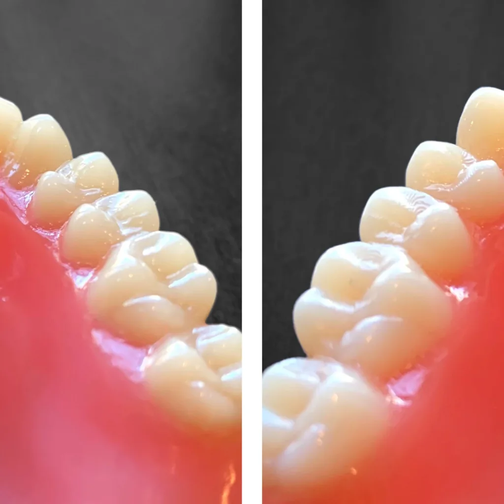 Abb. 1: Gefräste Prothesenzähne (links) und gedruckte Prothesenzähne (rechts): Zu erkennen ist der schichtweise Aufbau des Drucks. Die entstandenen Stufen müssen in diesem Fall manuell geglättet werden, um der vermehrten Plaquebildung entgegenzuwirken.