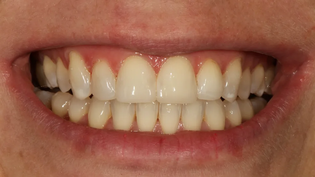 Abb. 16: Unmittelbar nach der Behandlung traut sich die Patientin bereits entspannter zu lachen.