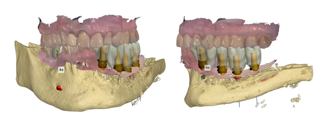 Abb. 2: Interdisziplinäre digitale Implantatplanung durch dreidimensionale Überlagerung von Intraoralscans mit einem DVT bei einem 73-jährigen Patienten vor implantatprothetischer Rehabilitation. Aufgrund eines großen Vertikalverlustes im dritten Quadranten erfolgte die Zahnaufstellung im Prämolarenbereich im Kopfbiss und im Molarenbereich im Kreuzbiss (links: Frontalansicht, rechts: Lateralansicht links).