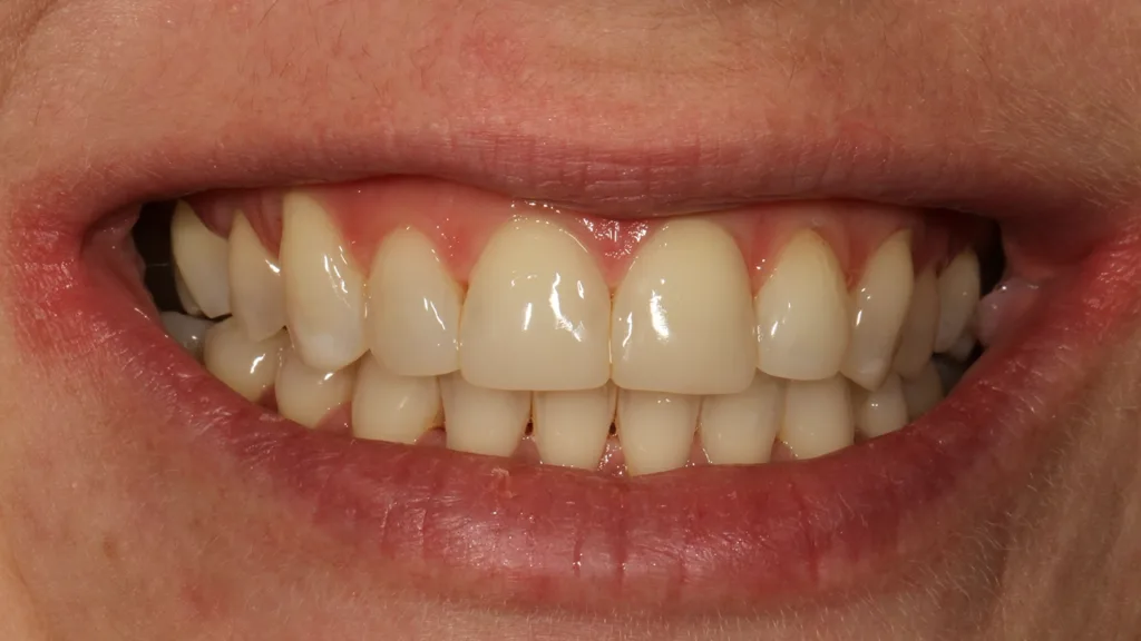 Abb. 21: Lippenbild bei einer Kontrolle nach einem Jahr.