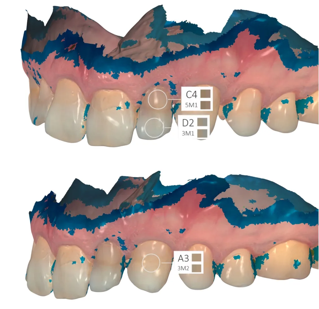 Abb. 3: Exemplarisches Beispiel der im Intraoralscanner Trios 5 (3Shape) integrierten Zahnfarbenbestimmung des Zahnes 22 (links) und 23 (rechts) mit den standardisierten Farbsystemen VITA classical und VITA 3D-Master (Vita Zahnfabrik) bei einem 37-jährigen Patienten mit verschiedenfarbigen Kompositfüllungen.