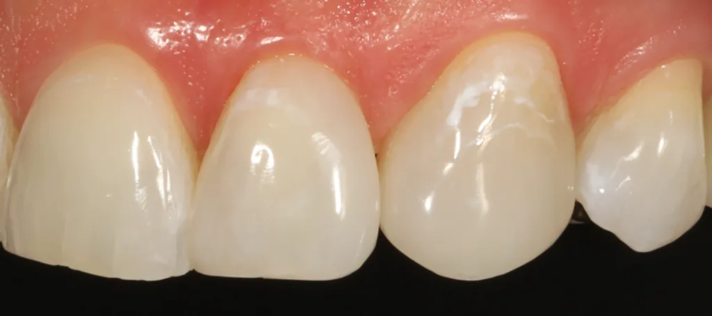 Abb. 36: Das Endergebnis überzeugt in Form und Farbe: 22: Filtek Supreme XTE A1B, 23: Venus Pearl Pure Light.