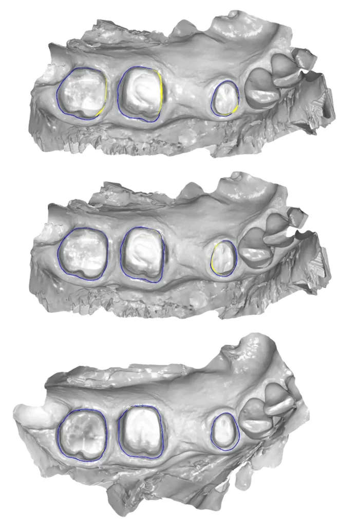 Abb. 4: Präparationsanalyse der Einschubrichtung unter Präparation der Zähne 44, 46 und 47 bei einer 70-jährigen Patientin (gelbe Markierung zeigt Unterschnitt an).