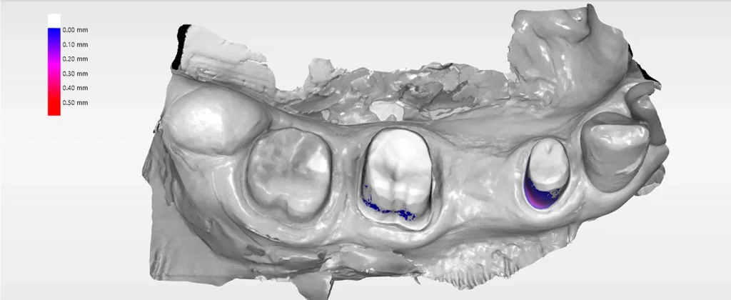 Abb. 5: Präparationsanalyse der Unterschnitte unter Präparation der Zähne 44 und 46 bei einer 70-jährigen Patientin (blaue und violette Markierung zeigen Unterschnitte an).