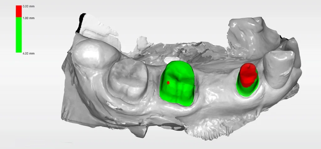 Abb. 6: Präparationsanalyse des Abstands zwischen Präparation und Antagonisten unter Präparation der Zähne 44 und 46 bei einer 70-jährigen Patientin (rot markiert einen zu geringen Zahnhartsubstanzabtrag, grün markiert einen ausreichenden Zahnhartsubstanzabtrag).