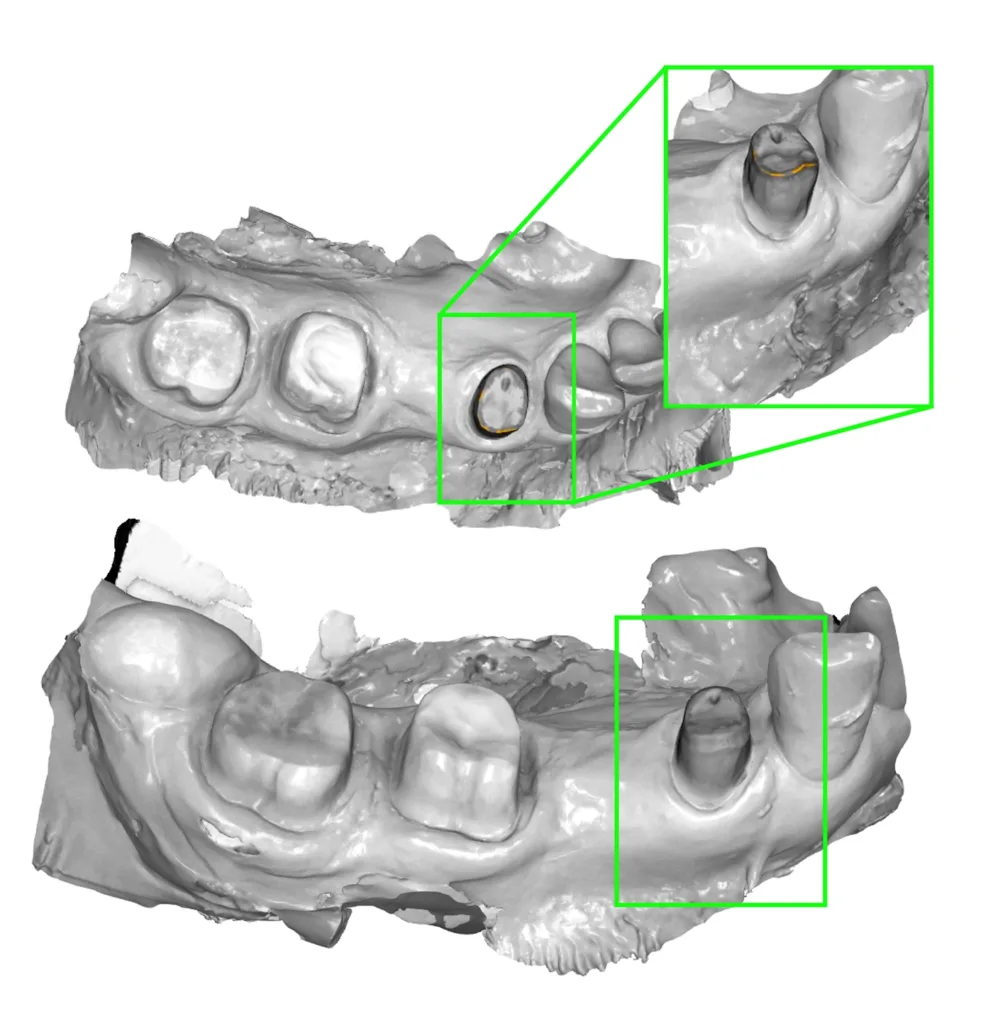 Abb. 7: Präparationsanalyse der Oberfläche des Zahnes 44 bei einer 70-jährigen Patientin mit zunächst scharfer Kante in orange markiert (oben) und anschließend geglätteter Kante (unten).