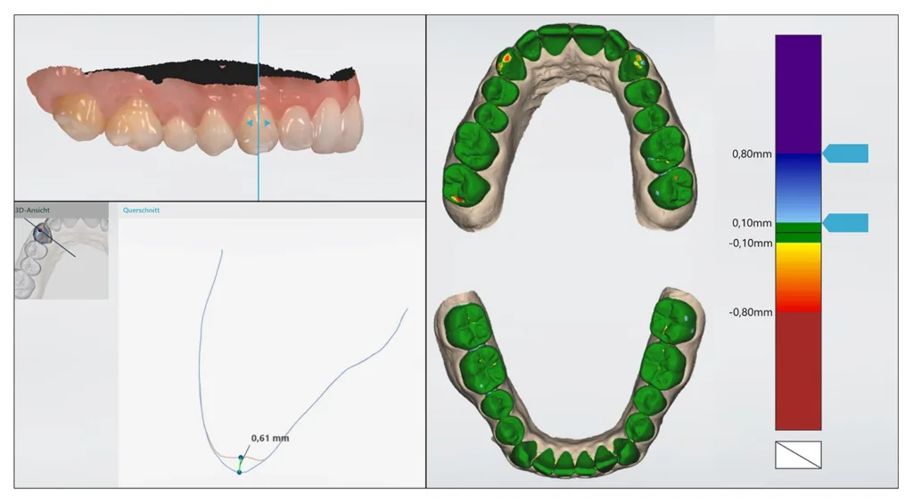 Abb. 8: Monitoring eines 28-jährigen Patienten mit der Überlagerung von Intraoralscans im Abstand von zwölf Monaten in der im Intraoralscanner Trios 5 (3Shape) integrierten Patient-Monitoringfunktion. Diese ermöglicht eine Simulation der zeitlichen Veränderungen über einen Schieberegler (oben links), Querschnittsansichten mit integriertem Vermessungstool zur Analyse einzelner Bereiche (unten links) sowie eine globale Farbkarte zur Visualisierung der Veränderungen (Zahnhartsubstanzverlust in gelb/rot dargestellt, rechts).