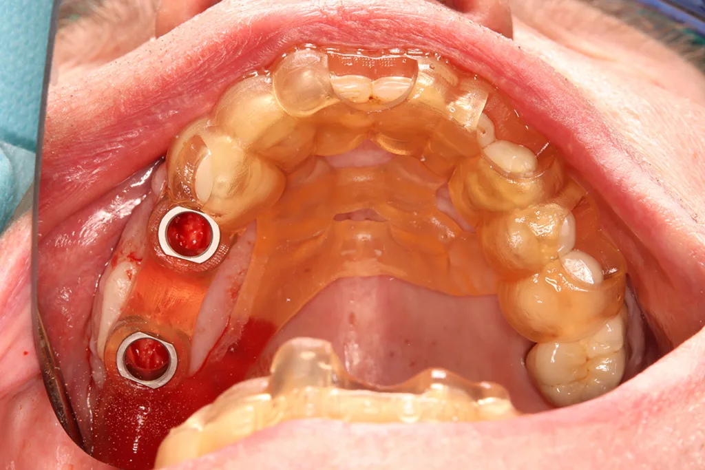 Abb. 10: Intraoral eingesetzte Bohrschablone zur statisch navigierten Implantation.