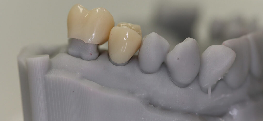 Provisorische 3D-gedruckte Kronen auf gedrucktem Modell (a), intraoral eingesetzte provisorische Kronen (b).