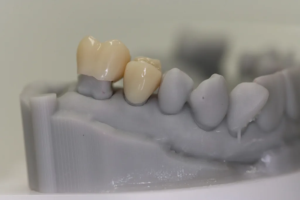 Abb. 4b: Provisorische 3D-gedruckte Kronen auf gedrucktem Modell (a), intraoral eingesetzte provisorische Kronen (b).