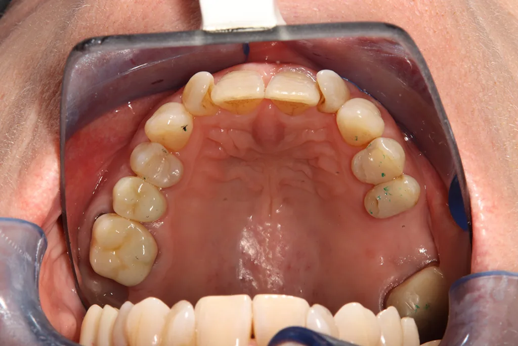 Abb. 4b: Provisorische 3D-gedruckte Kronen auf gedrucktem Modell (a), intraoral eingesetzte provisorische Kronen (b).