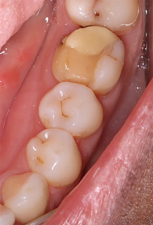 Abb. 5a: Permanente 3D-gedruckte Krone in regio 36; ein Vorher-nachher- Vergleich.