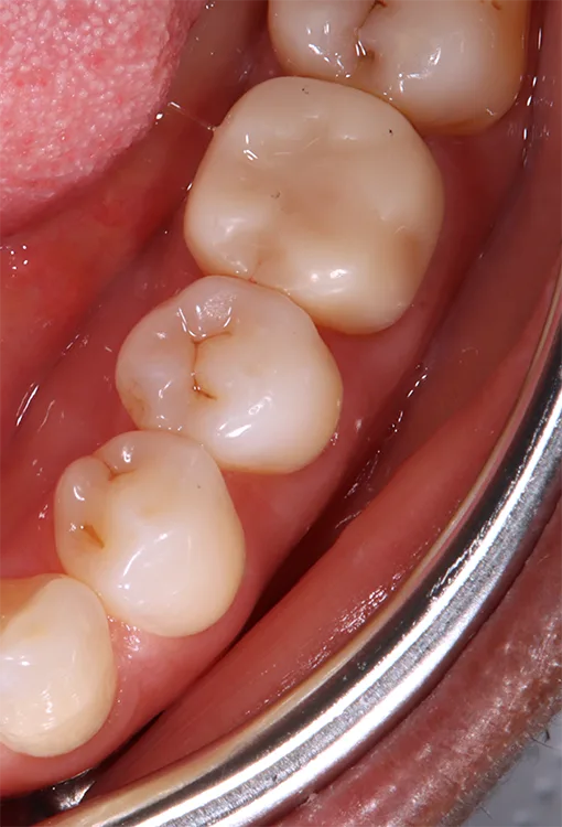 Abb. 5b: Permanente 3D-gedruckte Krone in regio 36; ein Vorher-nachher- Vergleich.