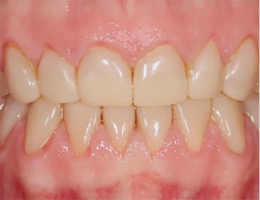 Abb. 8a: Volladhäsiv eingesetzte 3D-gedruckte Non-Prep-Langzeitprovisorien (links), Präparation über die belassenen Non-Prep-Langzeitprovisorien, welche als Aufbaufüllung vor permanentem Zahnersatz belassen wurden.