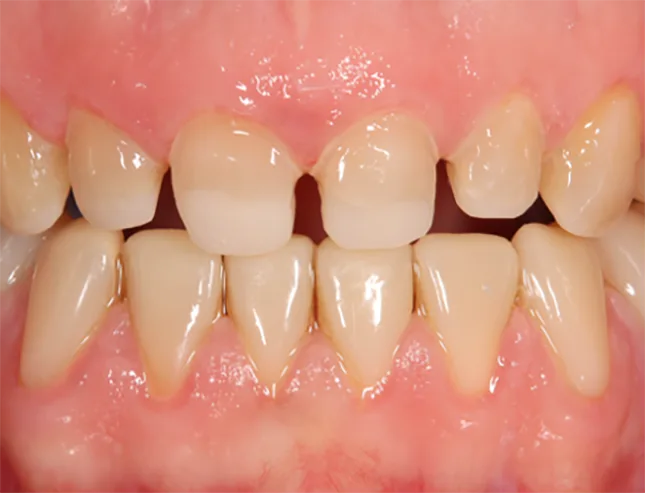 Abb. 8b: Volladhäsiv eingesetzte 3D-gedruckte Non-Prep-Langzeitprovisorien (links), Präparation über die belassenen Non-Prep-Langzeitprovisorien, welche als Aufbaufüllung vor permanentem Zahnersatz belassen wurden.